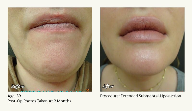 Chin Liposuction in Plano, TX - Patient 27
