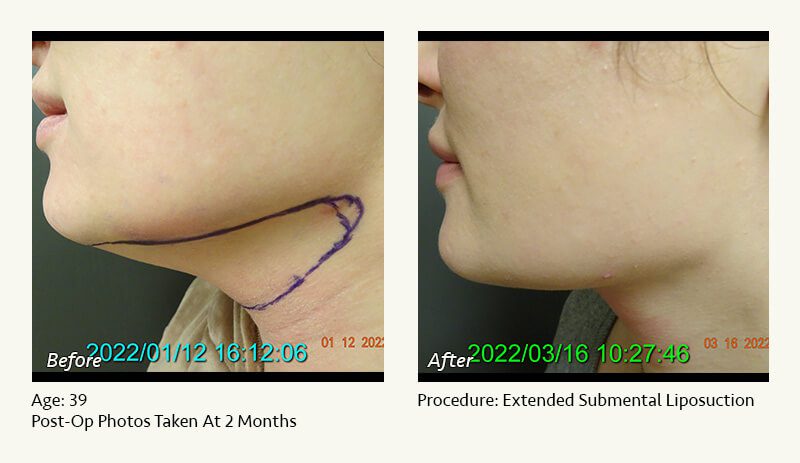Chin Liposuction in Plano, TX - Patient 28