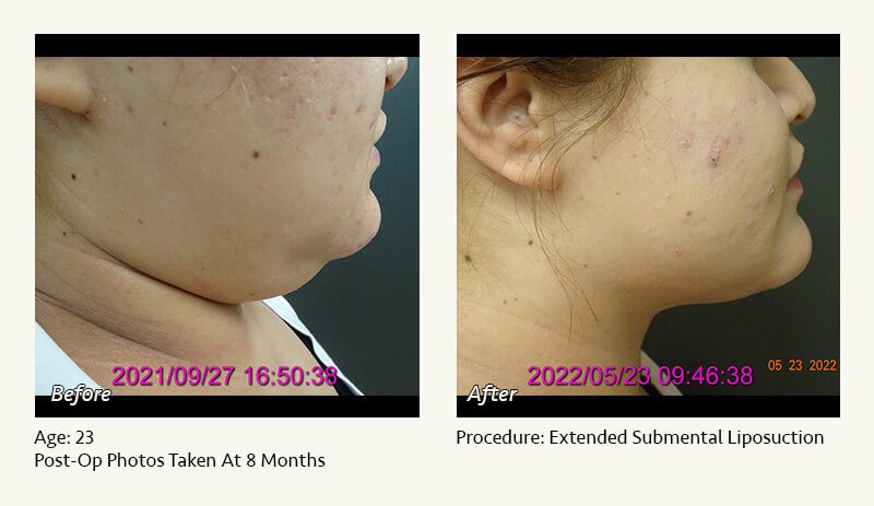 Chin Liposuction in Plano, TX - Patient 26