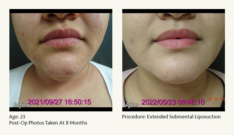 Chin Liposuction in Plano, TX - Patient 25
