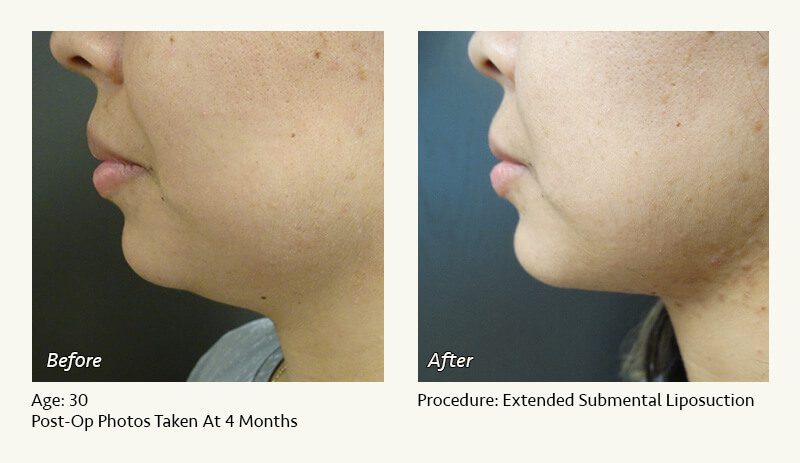 Chin Liposuction in Plano, TX - Patient 24