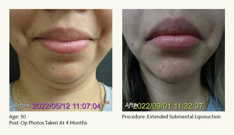 Chin Liposuction in Plano, TX - Patient 23