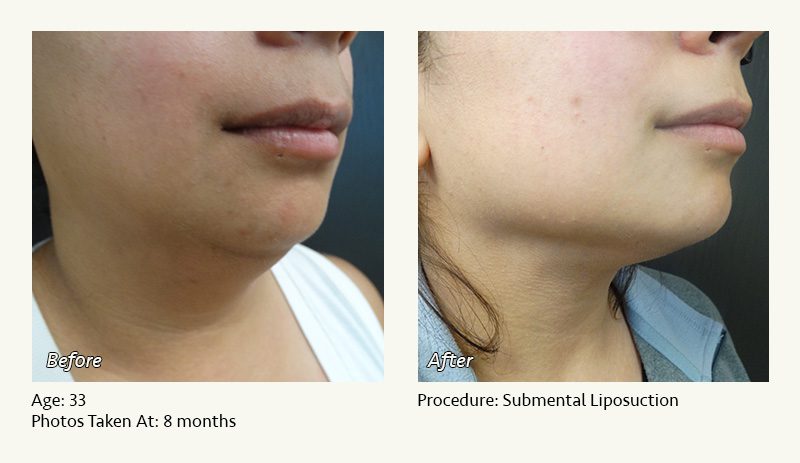 Chin Liposuction in Plano, TX - Patient 22