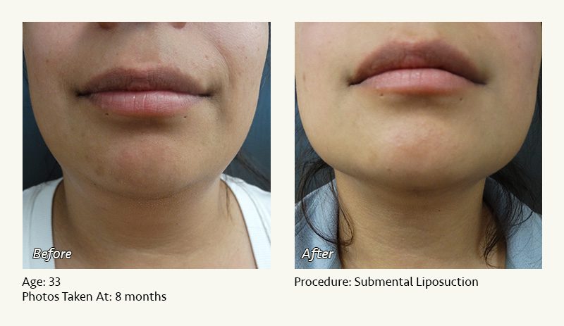 Chin Liposuction in Plano, TX - Patient 21