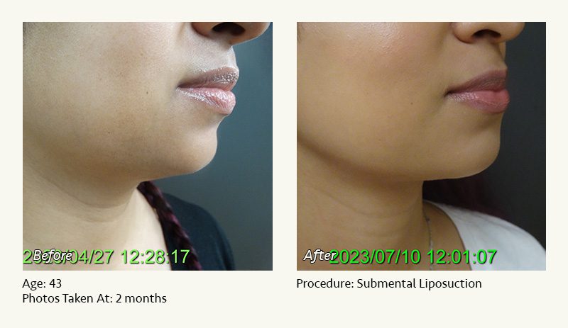 Chin Liposuction in Plano, TX - Patient 20