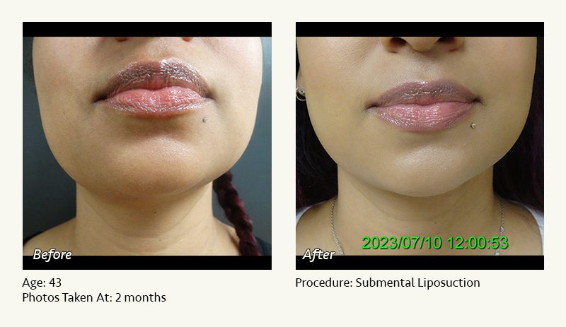 Chin Liposuction in Plano, TX - Patient 19
