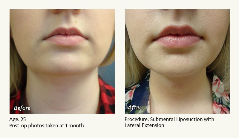 Chin Liposuction in Plano, TX - Patient 37