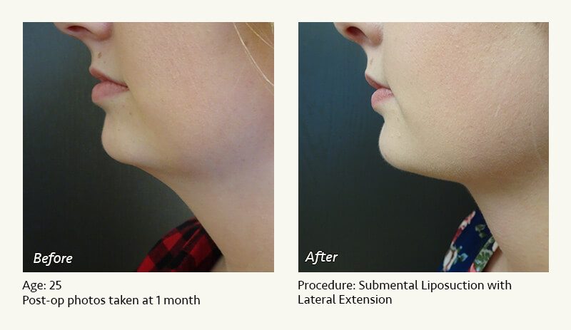 Chin Liposuction in Plano, TX - Patient 38