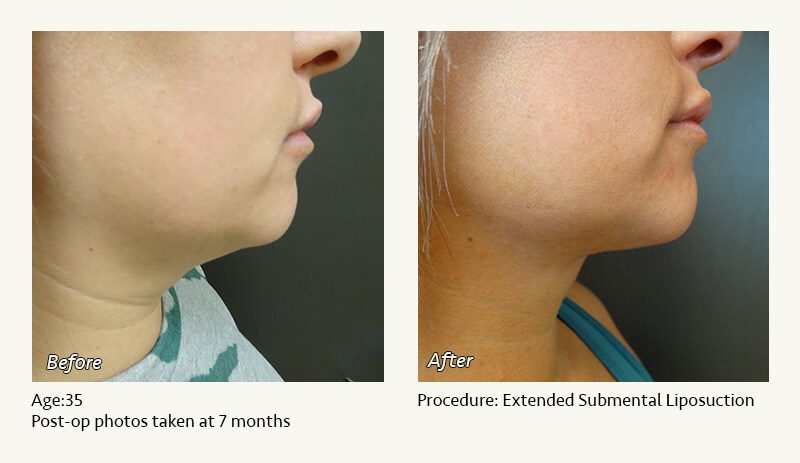 Chin Liposuction in Plano, TX - Patient 82