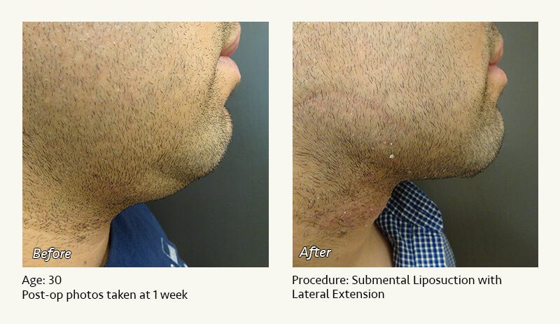 Chin Liposuction in Plano, TX - Patient 40