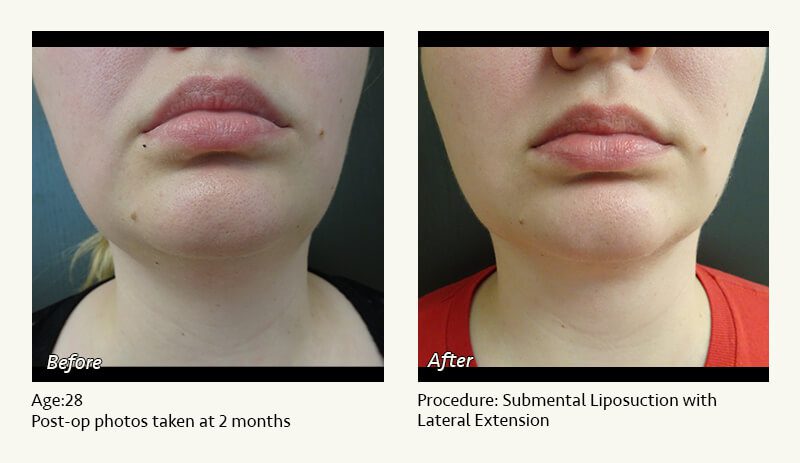 Chin Liposuction in Plano, TX - Patient 35