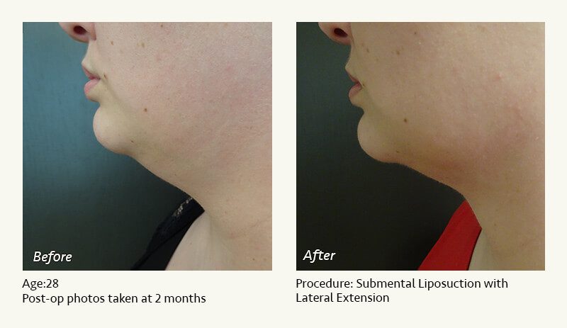 Chin Liposuction in Plano, TX - Patient 36