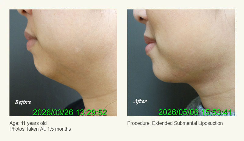 Chin Liposuction in Plano, TX - Patient 2