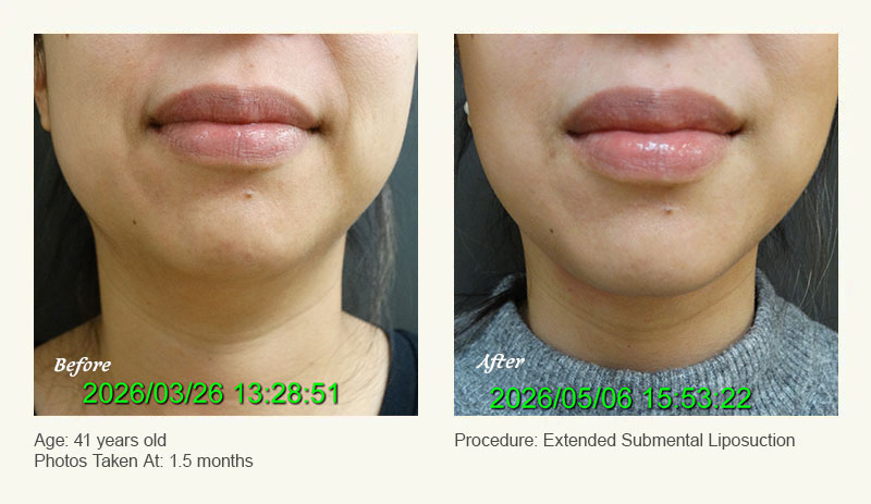 Chin Liposuction in Plano, TX - Patient 1