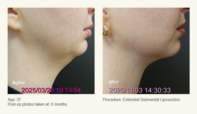 Chin Liposuction in Plano, TX - Patient 2