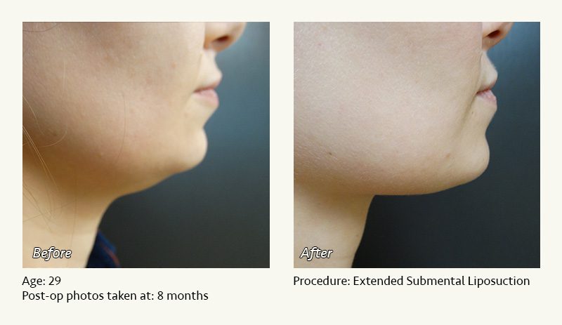 Chin Liposuction in Plano, TX - Patient 2