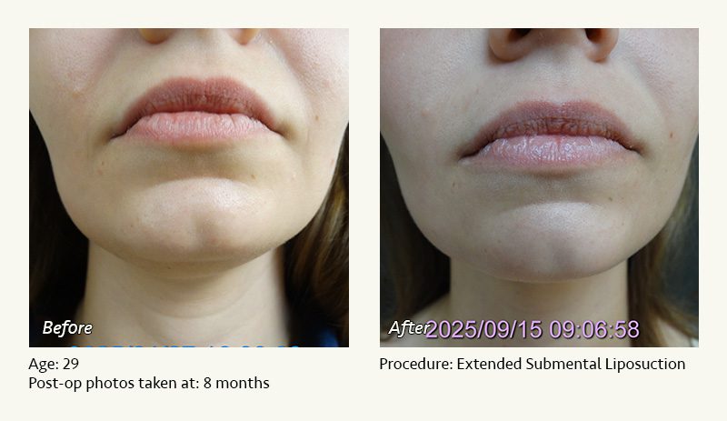 Chin Liposuction in Plano, TX - Patient 1