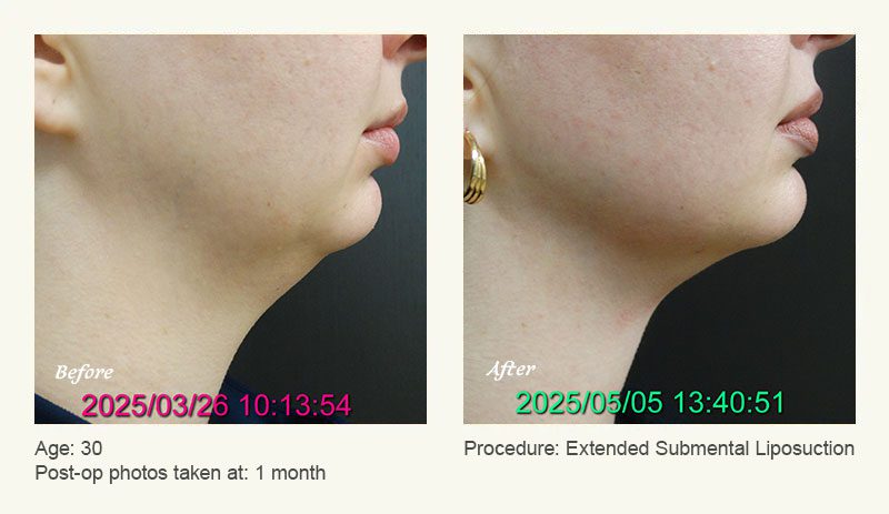 Chin Liposuction in Plano, TX - Patient 2