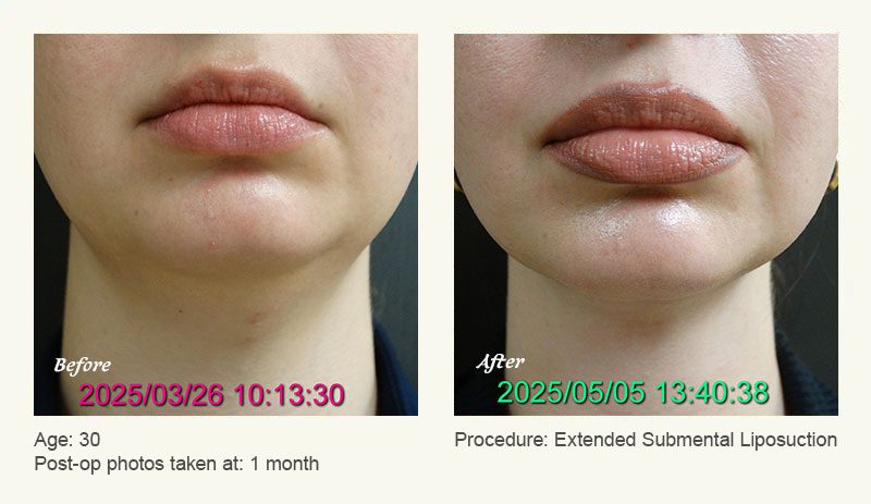 Chin Liposuction in Plano, TX - Patient 1