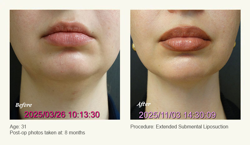Chin Liposuction in Plano, TX - Patient 1