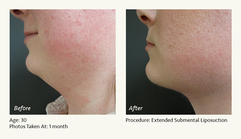 Chin Liposuction in Plano, TX - Patient 2