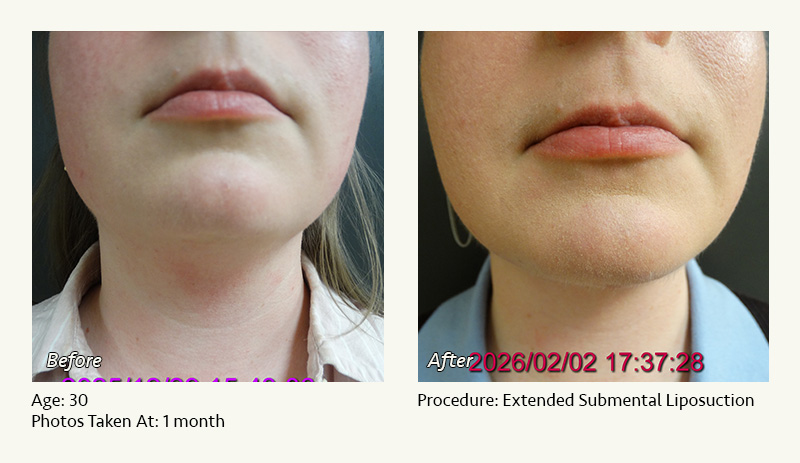 Chin Liposuction in Plano, TX - Patient 1