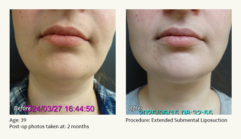 Chin Liposuction in Plano, TX - Patient 1