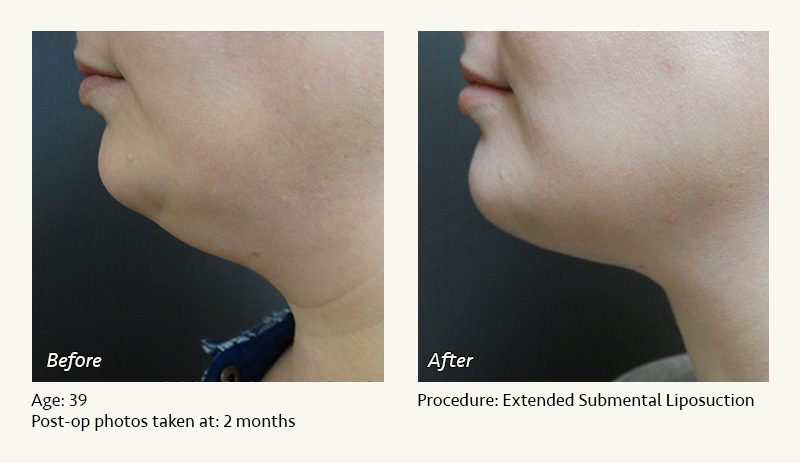 Chin Liposuction in Plano, TX - Patient 2