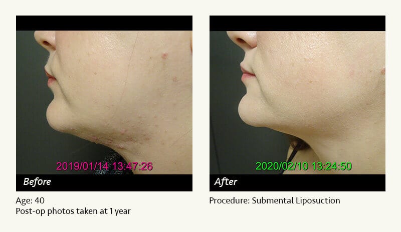 Chin Liposuction in Plano, TX - Patient 80