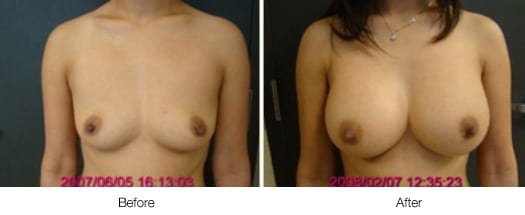 Before and After Breast Lift | Ronald M. Friedman