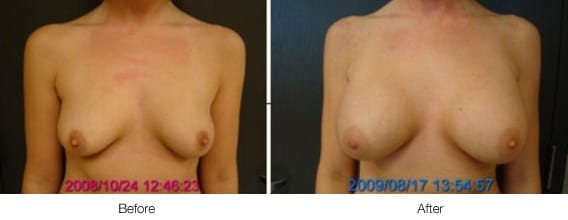 Before and After Breast Lift | Ronald M. Friedman