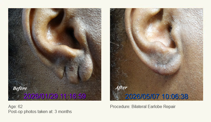 Earlobe Surgery in Plano, TX - Patient 2