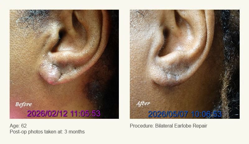 Earlobe Surgery in Plano, TX - Patient 1