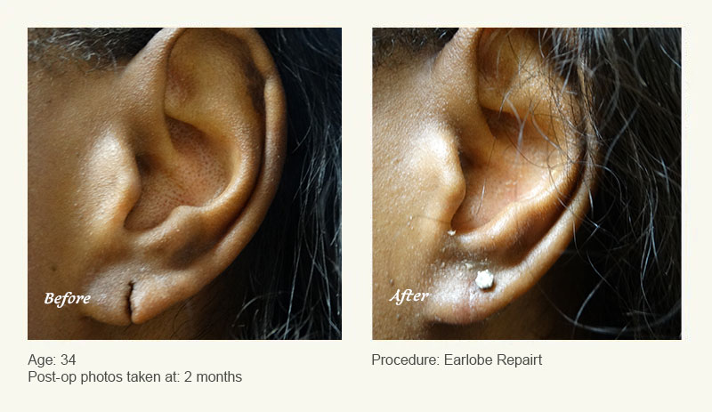 Earlobe Surgery in Plano, TX - Patient 3