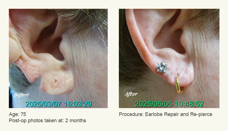 Earlobe Surgery in Plano, TX - Patient 1