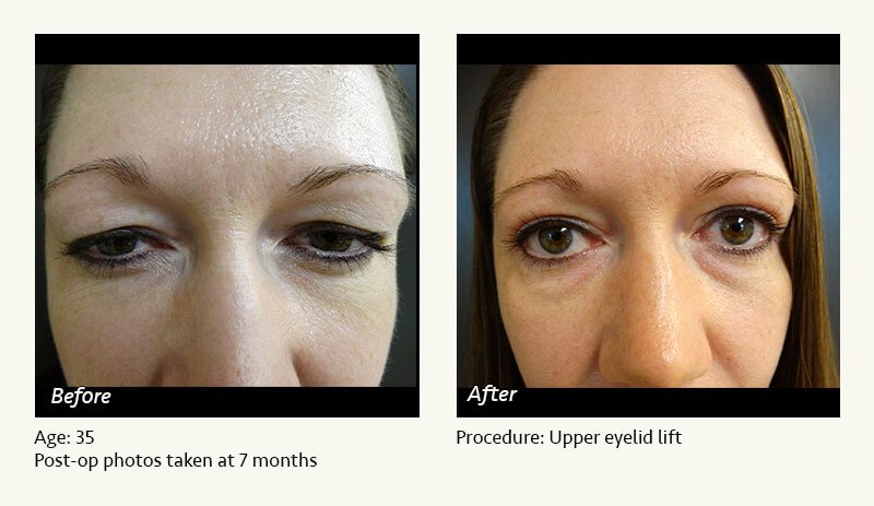 Eyelid Lift Surgery in Plano, TX - Patient 3