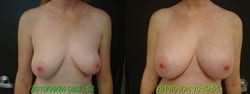 Breast Augmentation Results