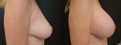 Breast Augmentation Results After