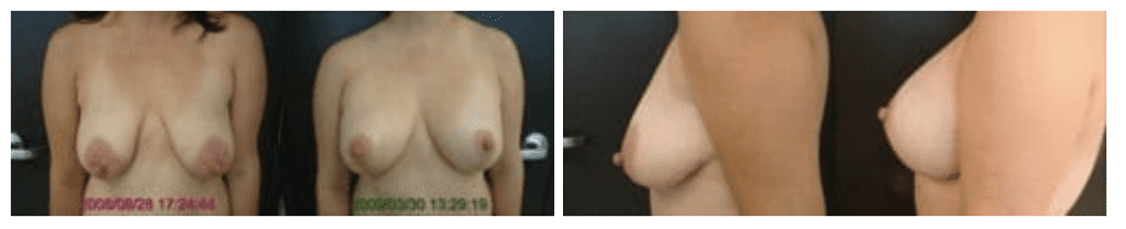 Breast Implant Actual Patient 2