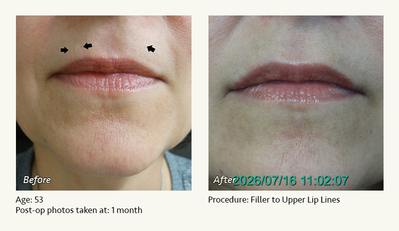 Restylane® & JUVÉDERM® Gel Injectable Fillers In Plano, TX - Patient 1