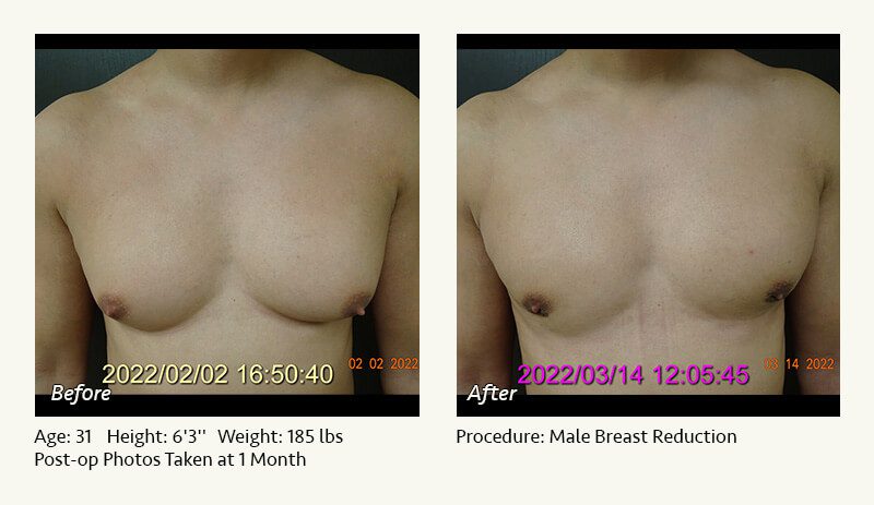 Male Breast Reduction Surgery in Plano, TX - Patient 39