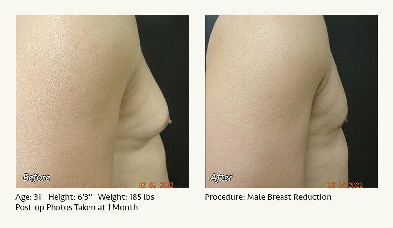 Male Breast Reduction Surgery in Plano, TX - Patient 40
