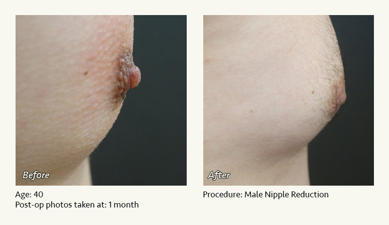 Male Nipple Reduction in Plano, TX - Patient 2