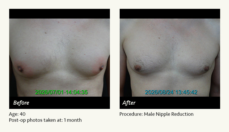 Male Nipple Reduction in Plano, TX - Patient 1