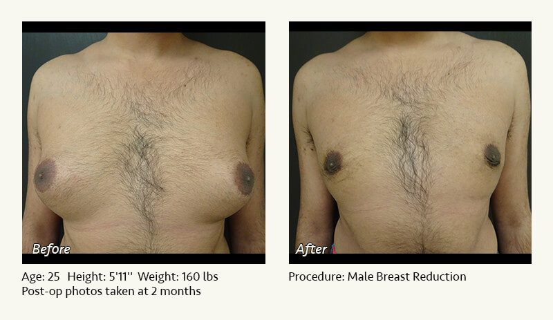 Male Breast Reduction Surgery in Plano, TX - Patient 15