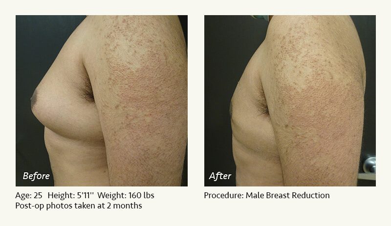 Male Breast Reduction Surgery in Plano, TX - Patient 16