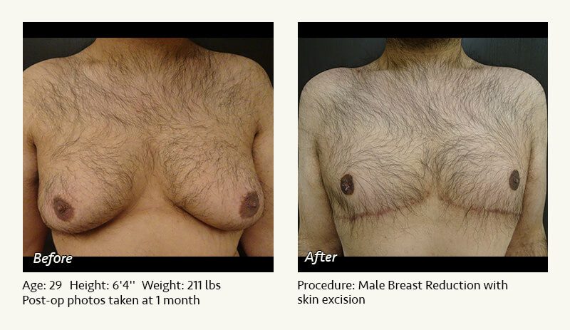 Male Breast Reduction Surgery in Plano, TX - Patient 19