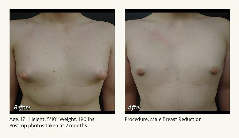 Male Breast Reduction Surgery in Plano, TX - Patient 17