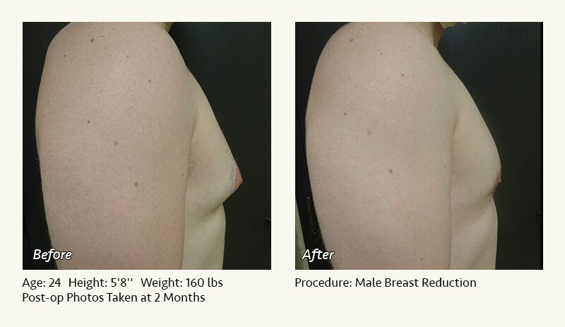 Male Breast Reduction Surgery in Plano, TX - Patient 14