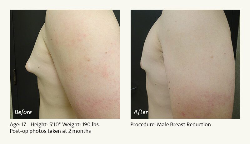 Male Breast Reduction Surgery in Plano, TX - Patient 18